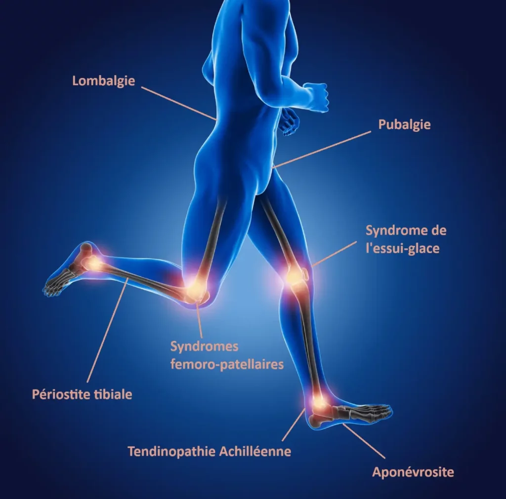 Pathologies des sportifs - Podologue Isigny-sur-Mer Manche Normandie